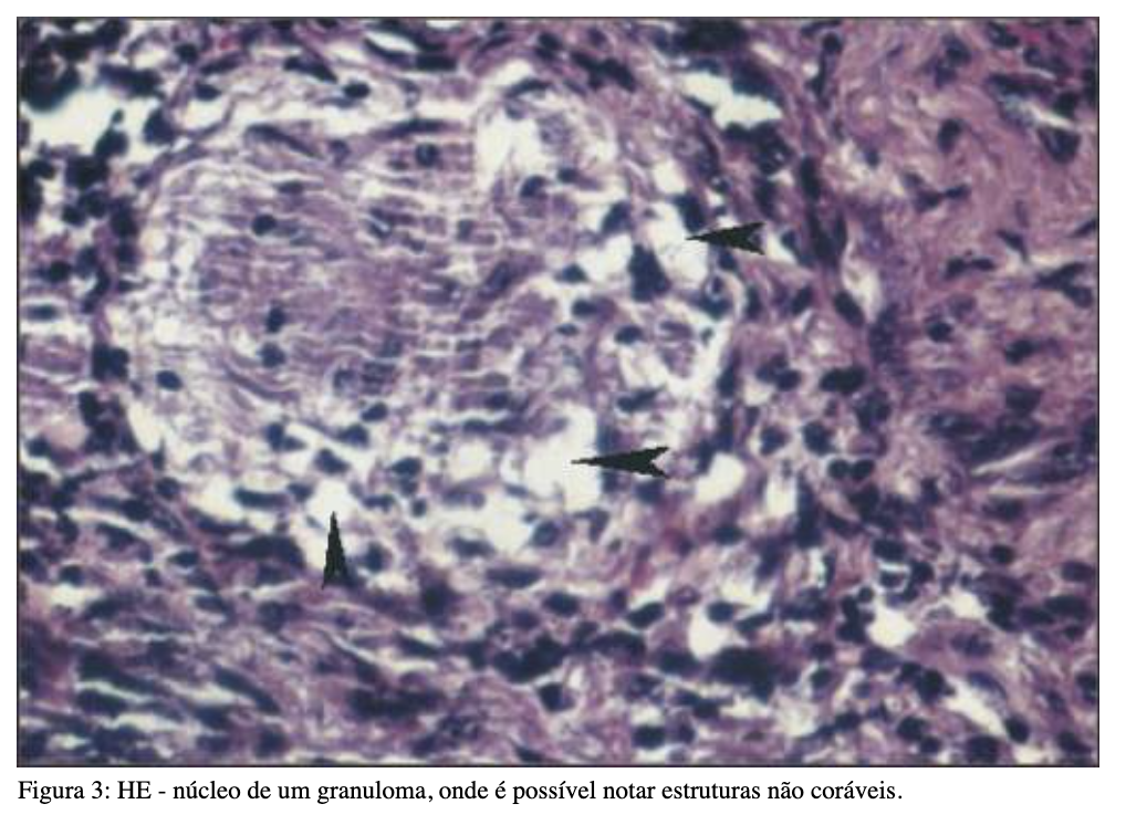 Imagem de Histoplasmose pulmonar.