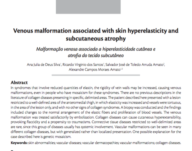 Imagem de Venous malformation associated with skin hyperelasticity and subcutaneous atrophy