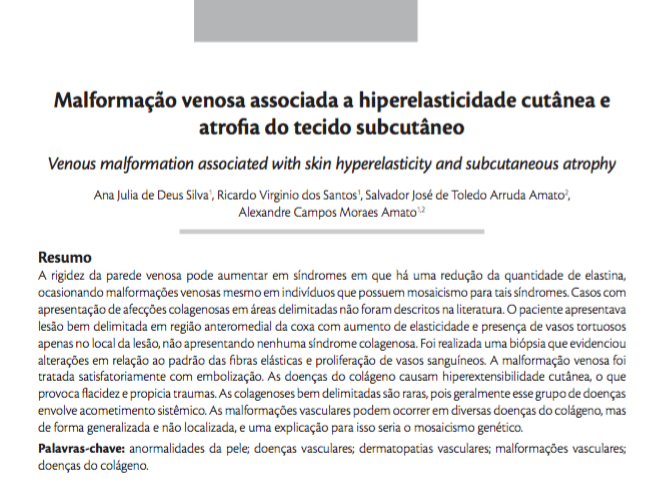 Imagem de Malformação venosa associada a hiperelasticidade cutânea e atrofia do tecido subcutâneo