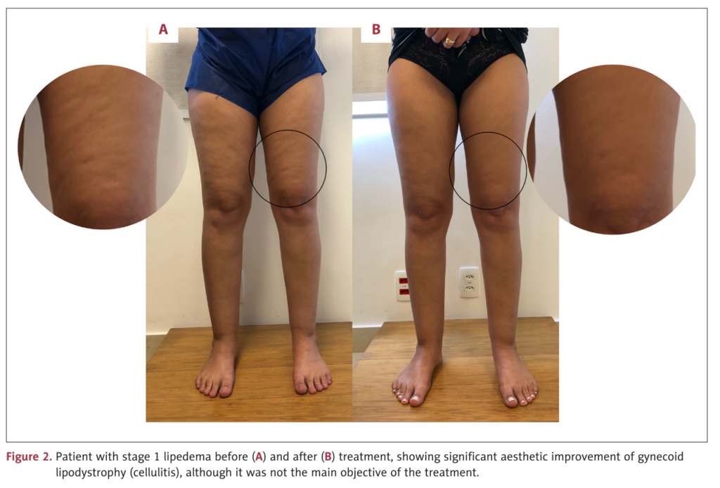 Antes e depois lipedema estágio 1