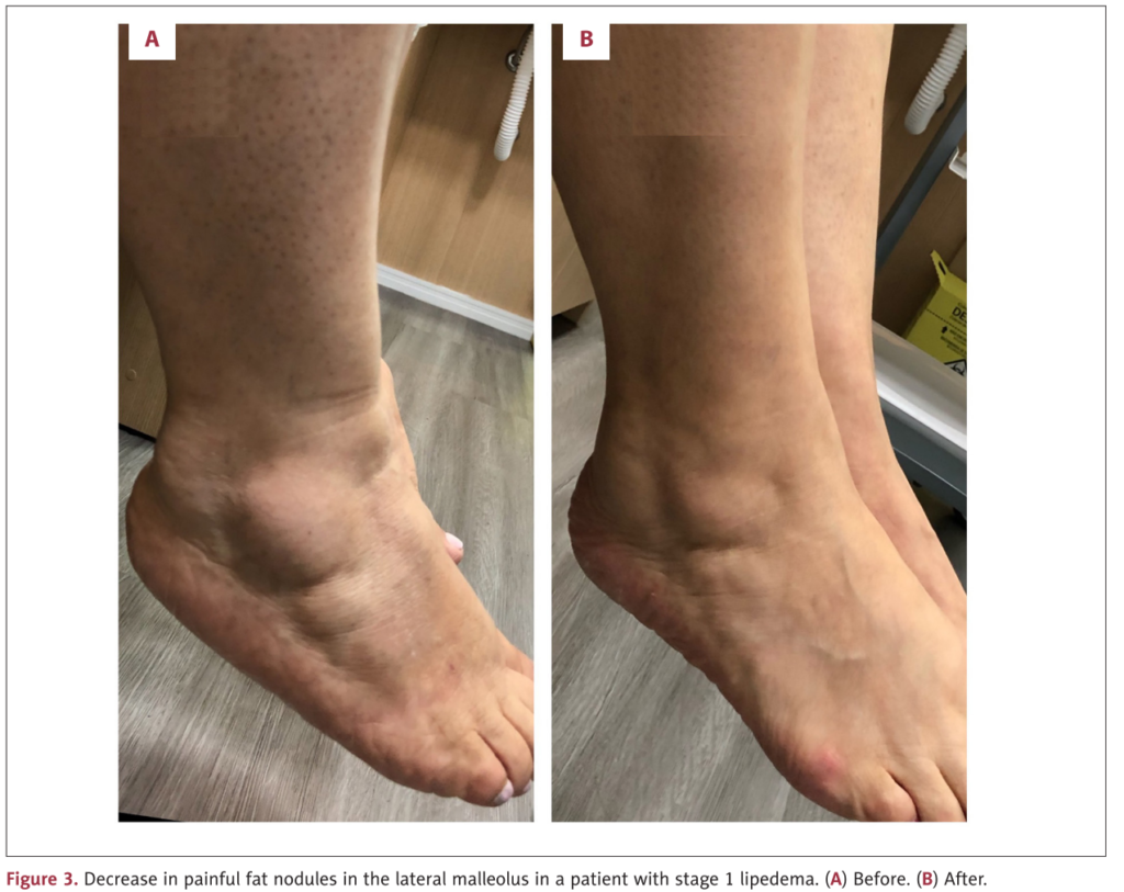 Antes e Depois estágio 2