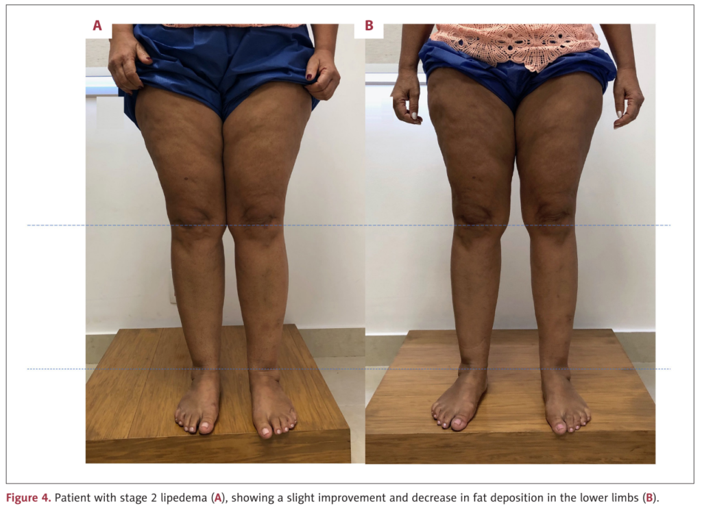 Antes e depois lipedema estágio 2