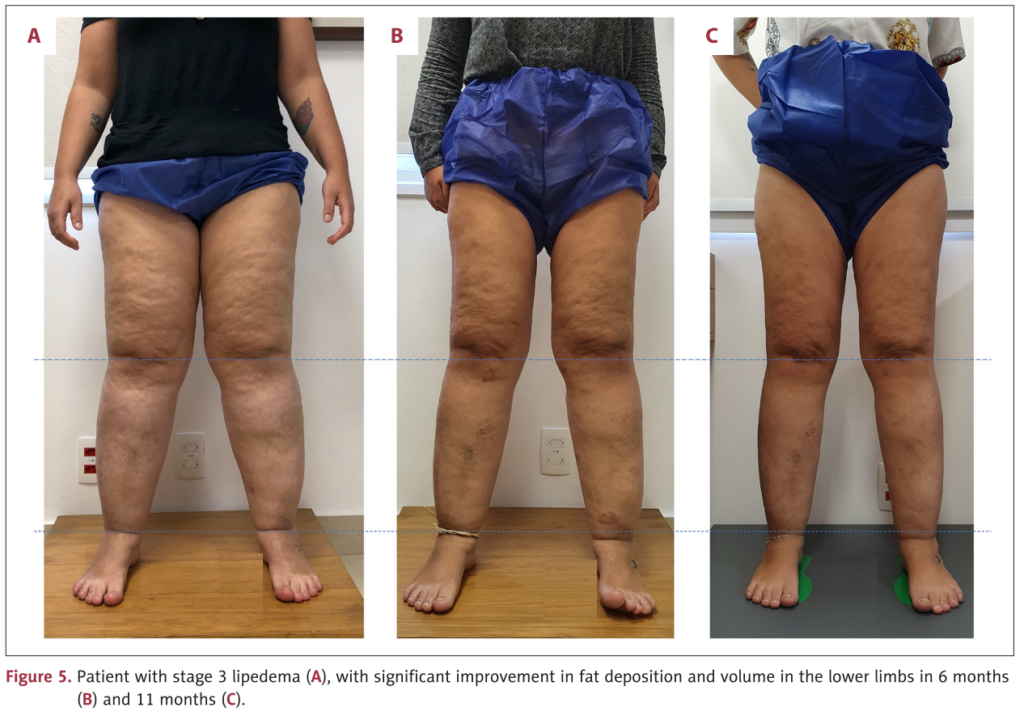Antes e Depois Lipedema estágio 3