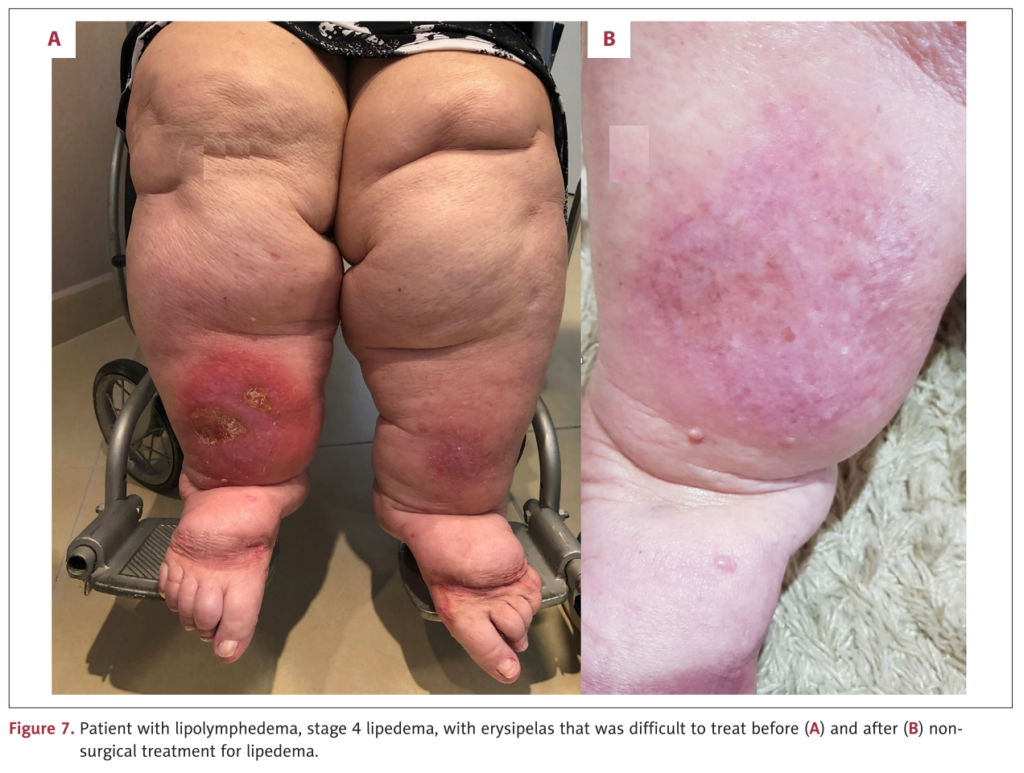 Antes e Depois Lipedema estágio 4