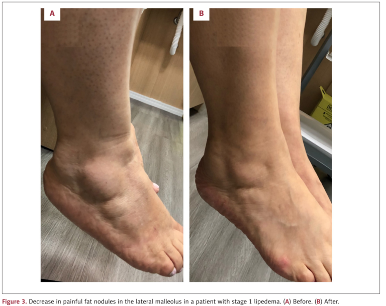 Lipedema Can Be Treated NonSurgically A Report of 5 Cases Vascular